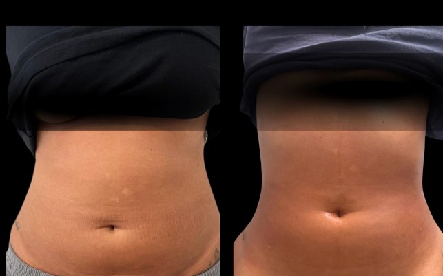 Antes e depois Endolaser barriga
