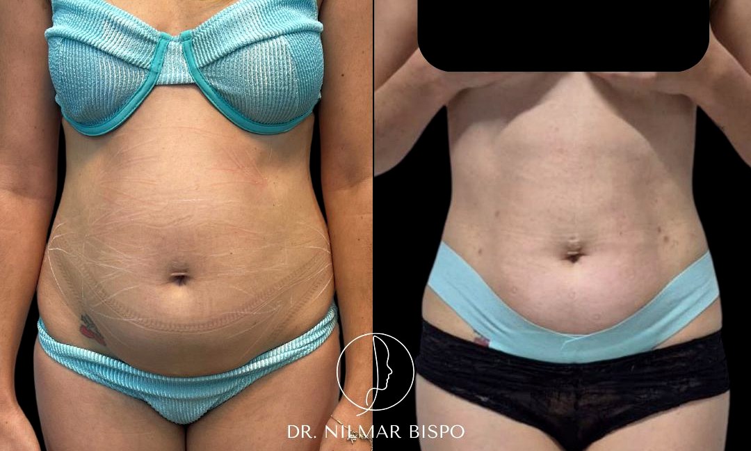 Resultado Endolaser - Redução de gordura abdominal